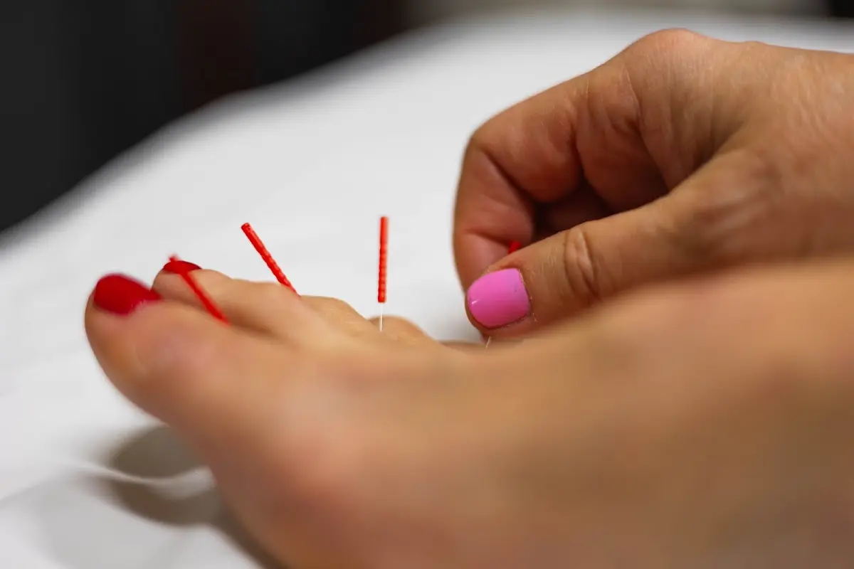Amy Adams Acupuncture — Acupuncture in Joyce Way, Dallas