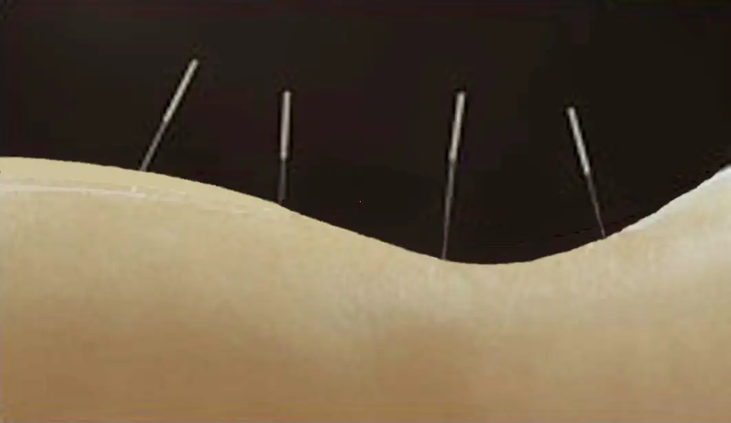Restorative Acupuncture Gilian Lata LAc, Dipl OM — Acupuncture in Encino, Los Angeles