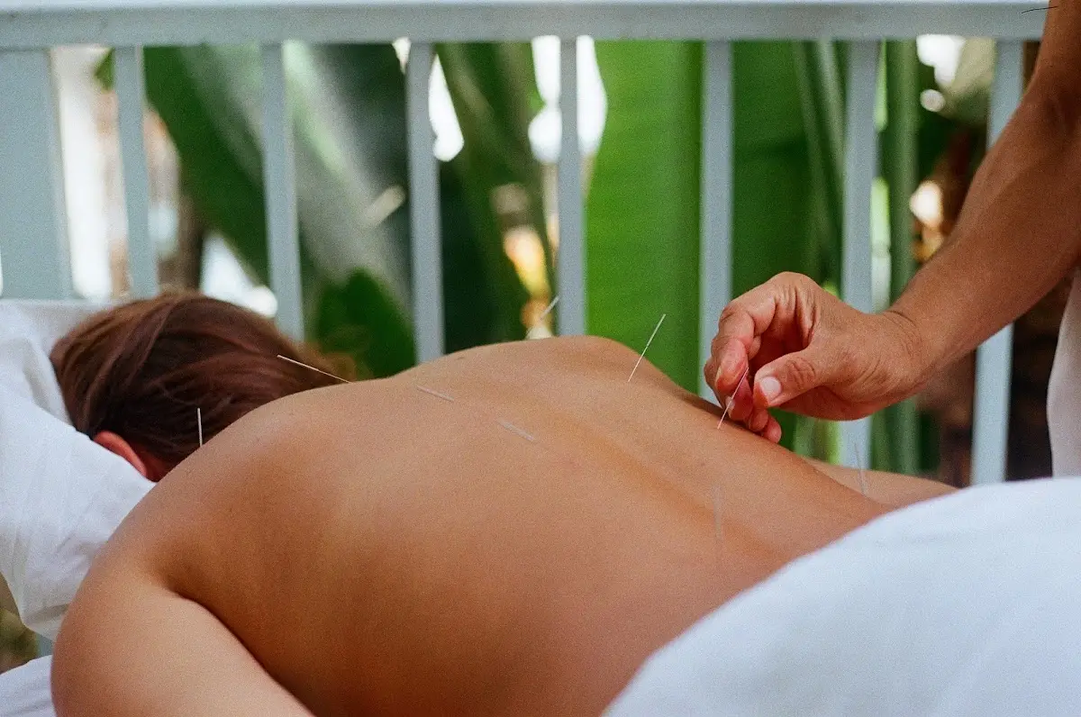 Acupuncture By Mia — Acupuncture in Miami Beach, Miami