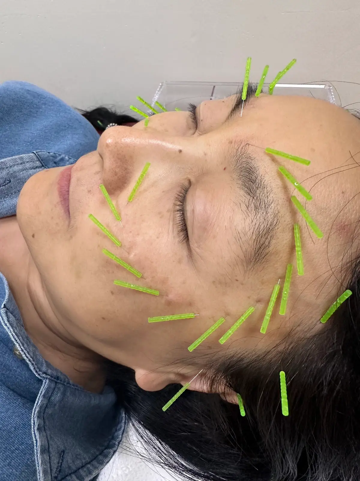 Hialeah Acupuncture Inc. — Acupuncture in Hialeah, Miami
