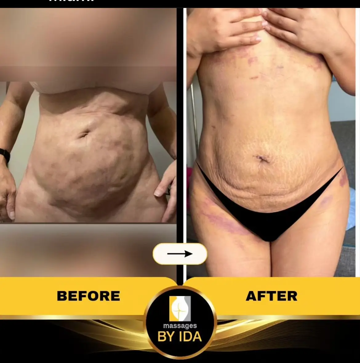 Lymphatic Massage By Ida Miami Fl — Massage Therapy in SW 8th St Apt 605, Miami