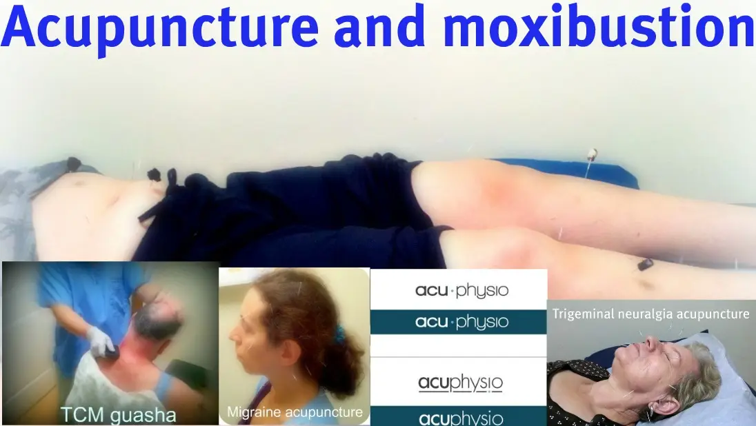 Acuphysio Acupuncture and Physical Therapy — Acupuncture in Staten Island, New York