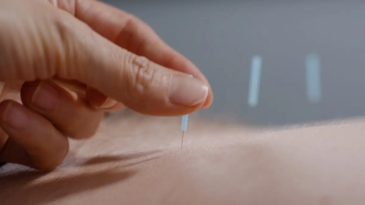 Kelly 121 Acupuncture — Acupuncture in E 60th St, New York