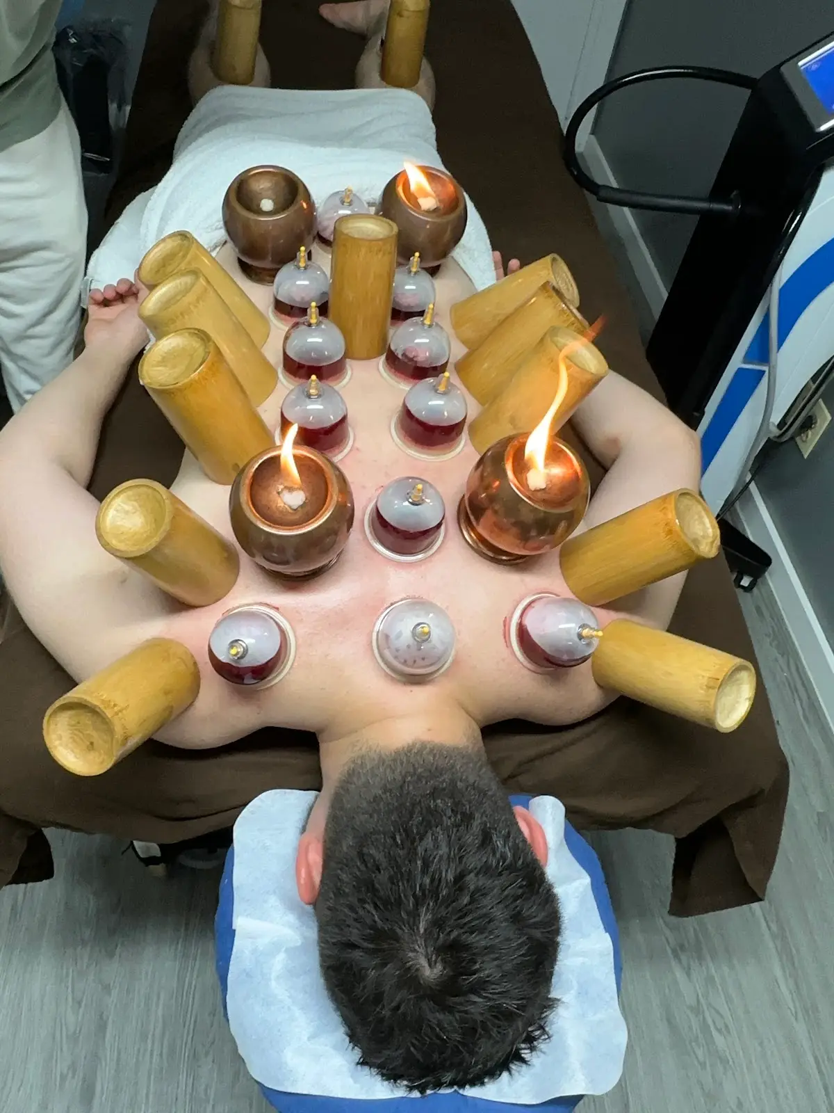 New York Hijama NYC — Cupping Therapy in Avenue U, New York